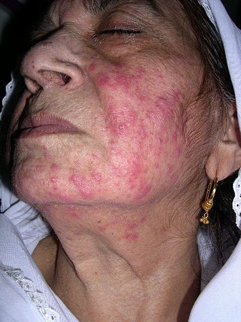 Rash on Face (Facial rash varies) Causes, Symptoms and ...